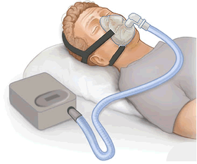 sleep apnea truth treatment options cpap machine continuous positive airway pressure