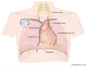 sleep apnea truth treatment options phrenic nerve stimulation remede fda